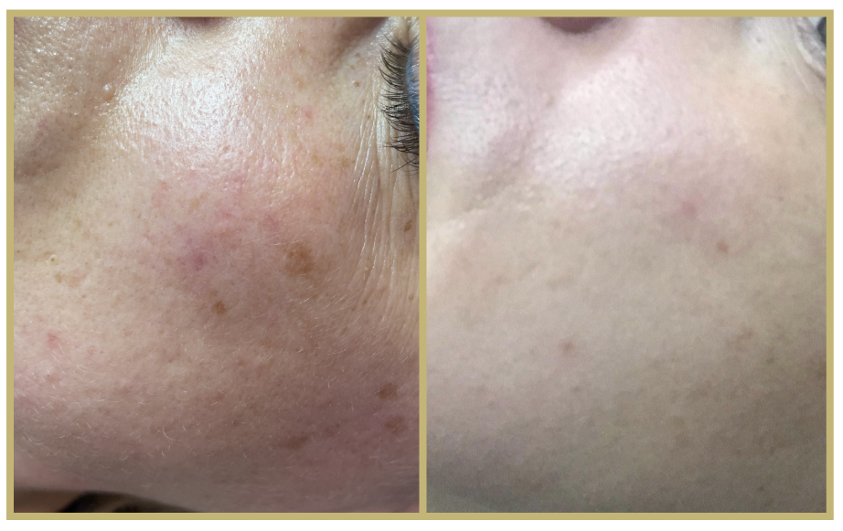 Pigmentation