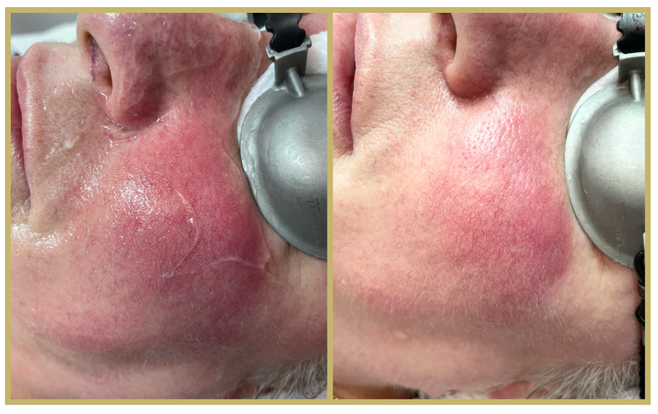Rosacea-2
