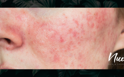 What Is The Best Treatment For Rosacea?