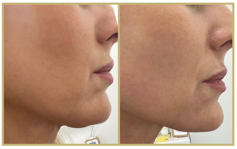 HIFU Treatment Results Milton Keynes Before and after HIFU treatment at Nue Skin & Laser Clinic, Milton Keyne