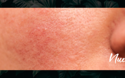 What Are The Most Common Rosacea Symptoms?￼